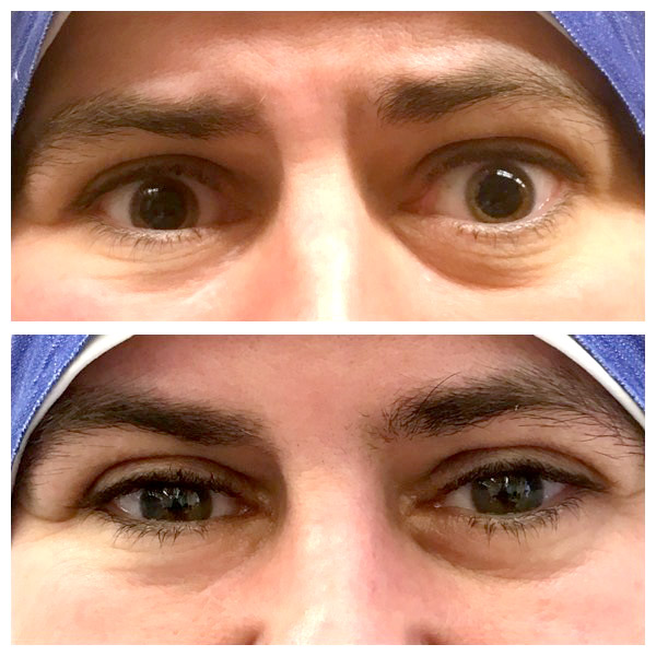 Eyelid surgery for GO before/after